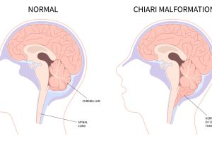 Chiari I malformation